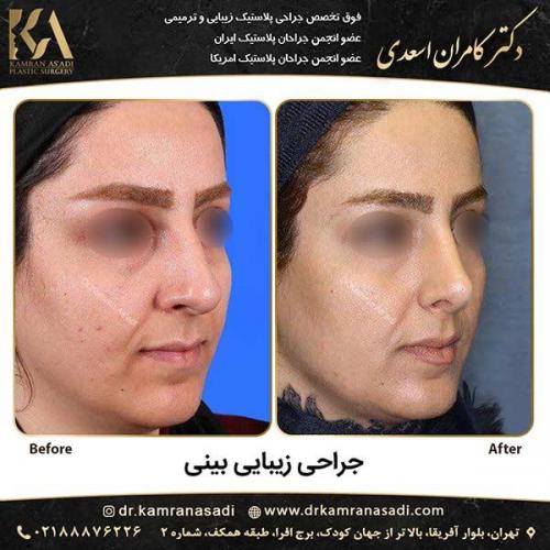 جراحی-بینی-دکتر-اسعدی-2-5