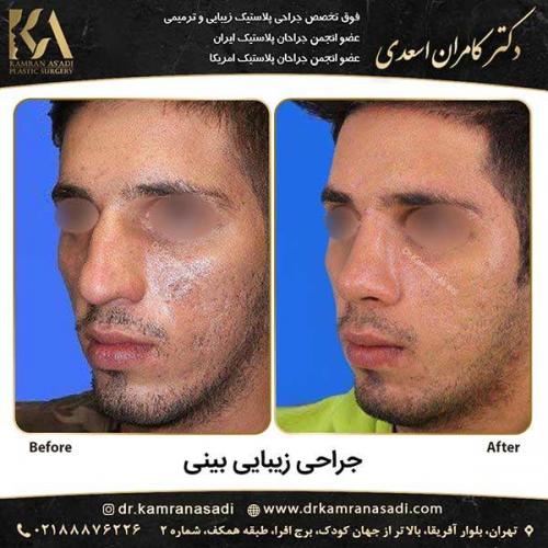 جراحی-بینی-دکتر-اسعدی-2-7