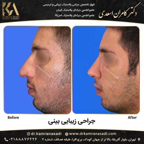 جراحی-بینی-دکتر-اسعدی-2-8