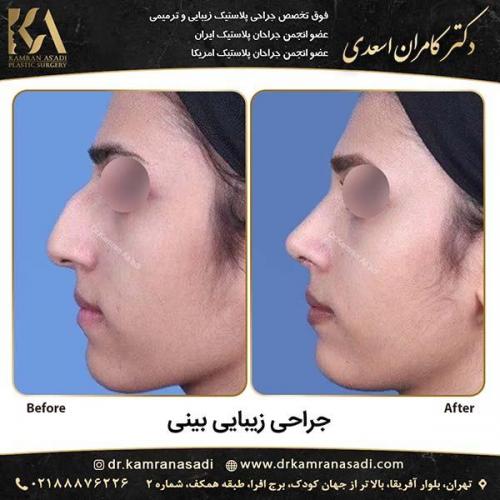 جراحی-بینی-دکتر-اسعدی-2-9