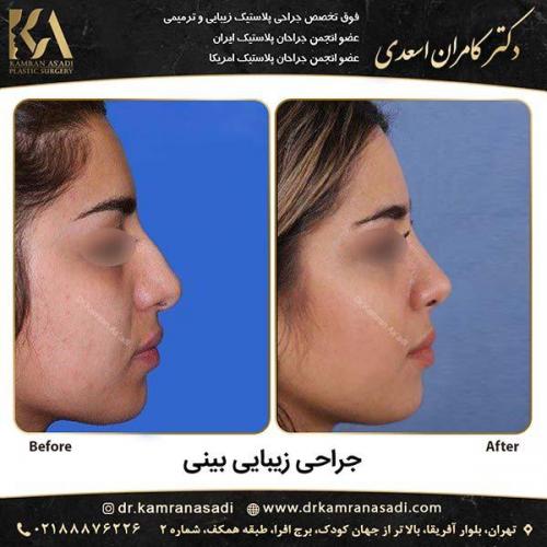جراحی-بینی-دکتر-اسعدی-3-1