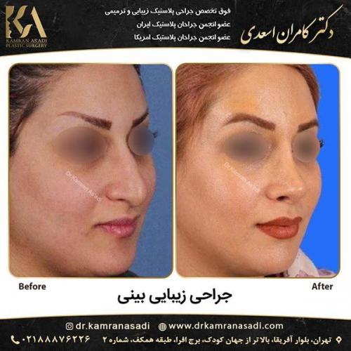 جراحی-بینی-دکتر-اسعدی-3-10