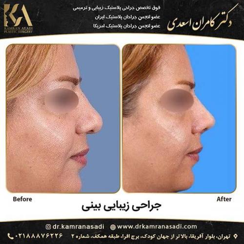 جراحی-بینی-دکتر-اسعدی-3-11