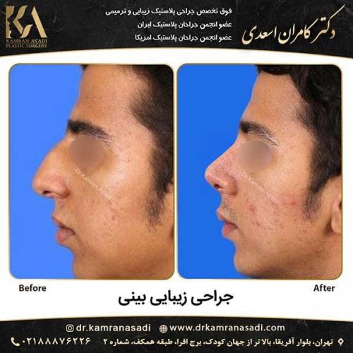 جراحی-بینی-دکتر-اسعدی-3-12