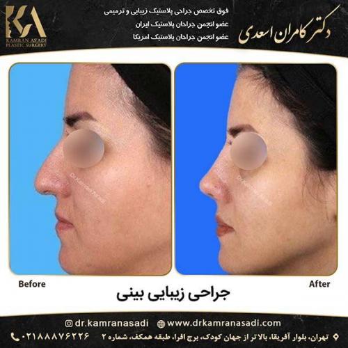 جراحی-بینی-دکتر-اسعدی-3-13