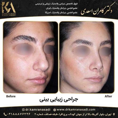 جراحی-بینی-دکتر-اسعدی-3-14