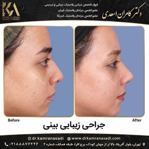 جراحی-بینی-دکتر-اسعدی-3-16