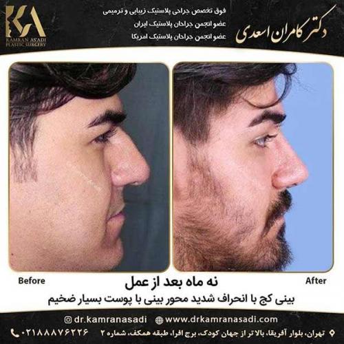 جراحی-بینی-دکتر-اسعدی-3-17
