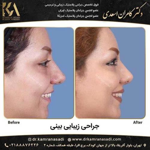 جراحی-بینی-دکتر-اسعدی-3-18