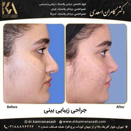 جراحی-بینی-دکتر-اسعدی-3-19