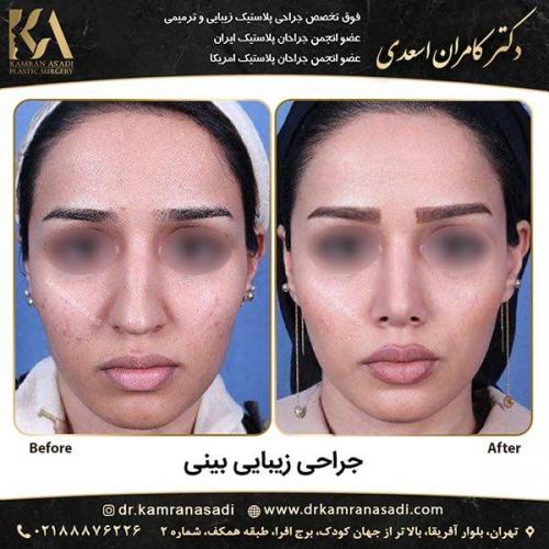 جراحی-بینی-دکتر-اسعدی-3-2
