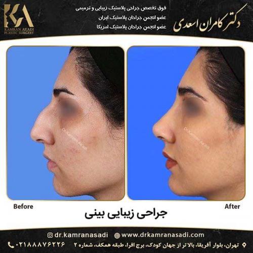جراحی-بینی-دکتر-اسعدی-3-3