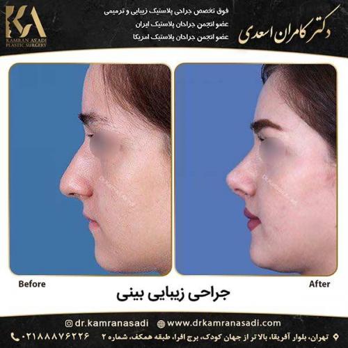 جراحی-بینی-دکتر-اسعدی-3-4