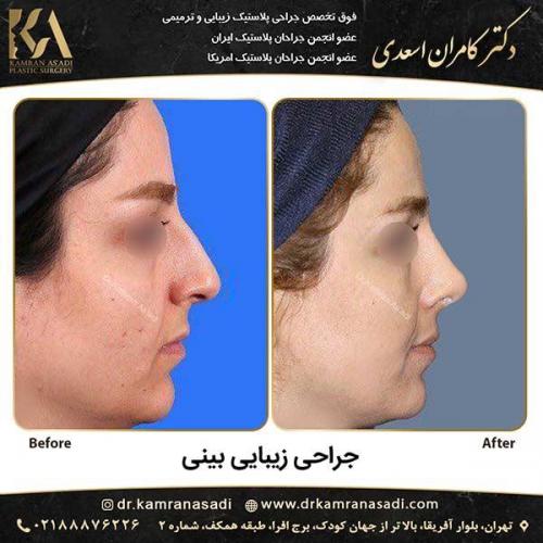 جراحی-بینی-دکتر-اسعدی-3-5