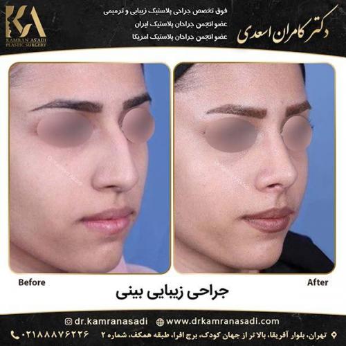 جراحی-بینی-دکتر-اسعدی-3-9