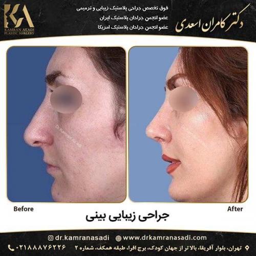 جراحی-بینی-دکتر-اسعدی-315