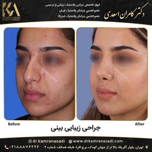 جراحی-بینی-دکتر-اسعدی-4-1