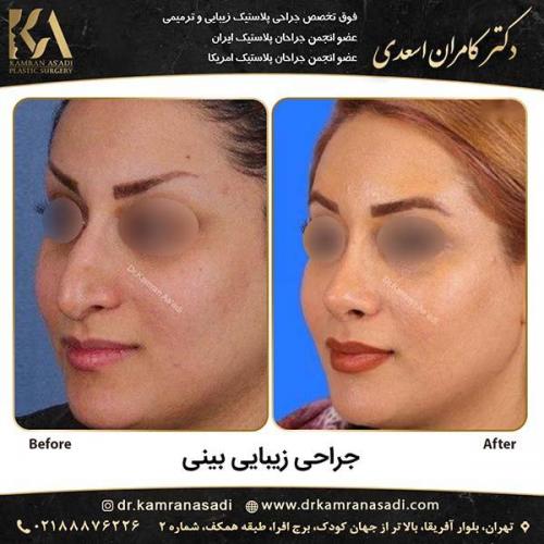 جراحی-بینی-دکتر-اسعدی-4-10