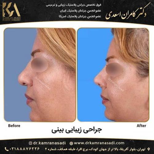 جراحی-بینی-دکتر-اسعدی-4-11