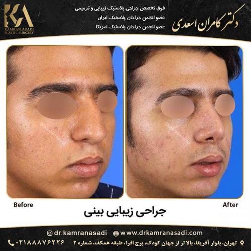 جراحی-بینی-دکتر-اسعدی-4-12