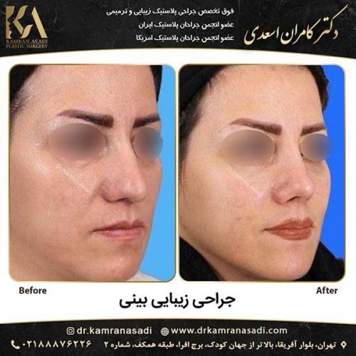 جراحی-بینی-دکتر-اسعدی-4-13