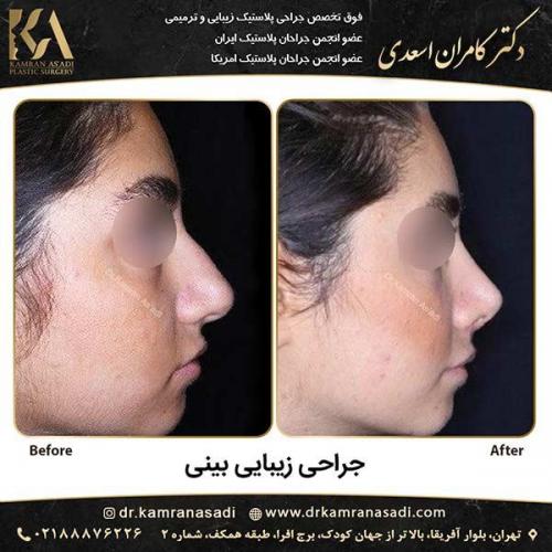 جراحی-بینی-دکتر-اسعدی-4-14