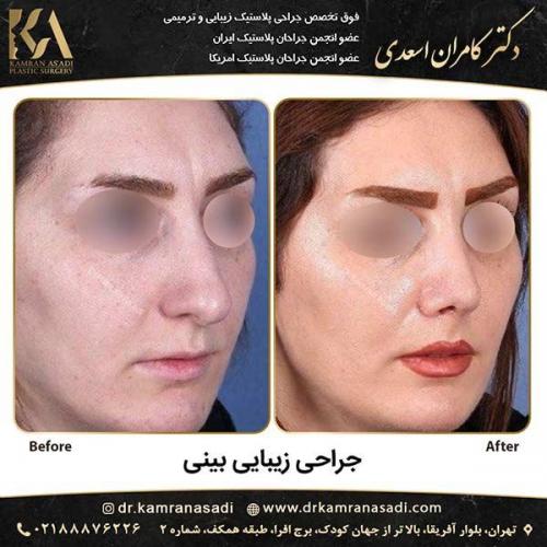 جراحی-بینی-دکتر-اسعدی-4-15