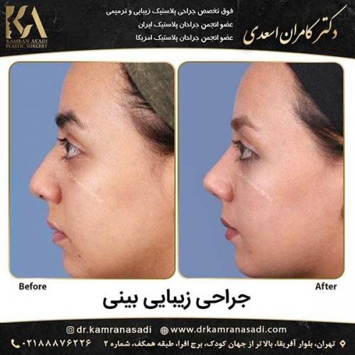 جراحی-بینی-دکتر-اسعدی-4-16