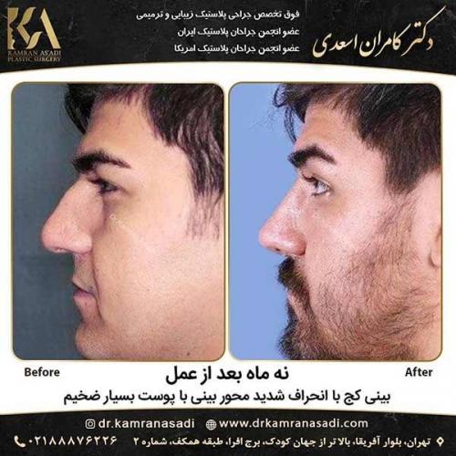 جراحی-بینی-دکتر-اسعدی-4-17