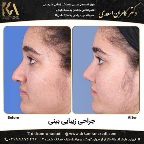 جراحی-بینی-دکتر-اسعدی-4-19