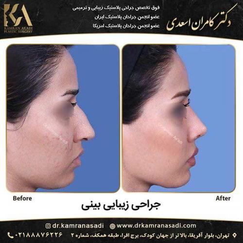 جراحی-بینی-دکتر-اسعدی-4-2
