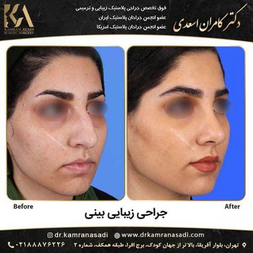 جراحی-بینی-دکتر-اسعدی-4-3