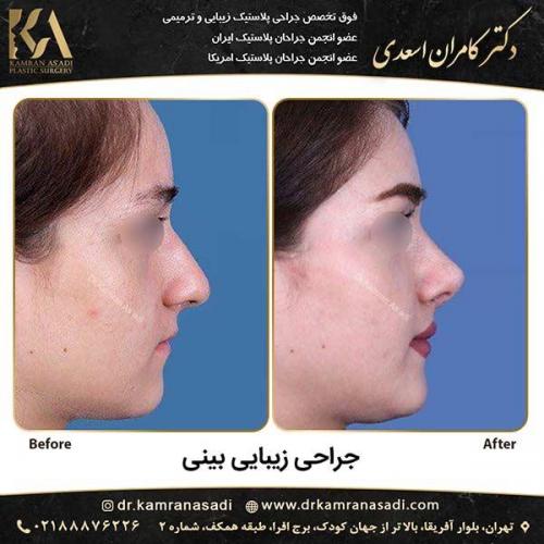 جراحی-بینی-دکتر-اسعدی-4-4