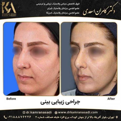 جراحی-بینی-دکتر-اسعدی-4-5