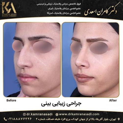 جراحی-بینی-دکتر-اسعدی-4-9