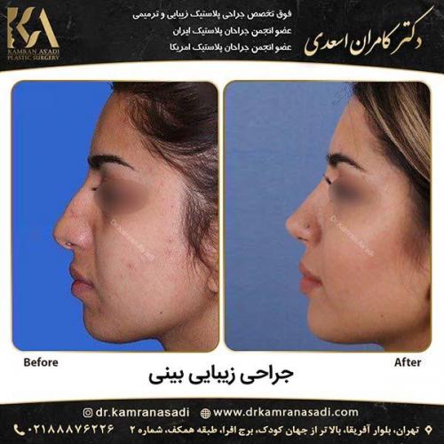 جراحی-بینی-دکتر-اسعدی-5-1