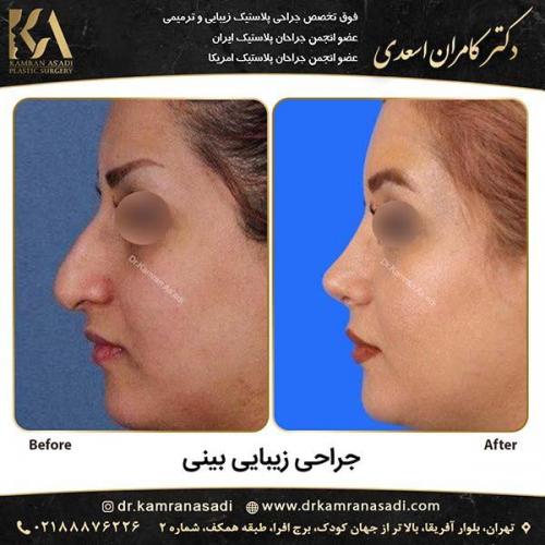 جراحی-بینی-دکتر-اسعدی-5-10