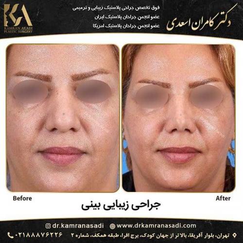 جراحی-بینی-دکتر-اسعدی-5-11