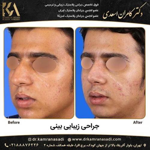 جراحی-بینی-دکتر-اسعدی-5-12