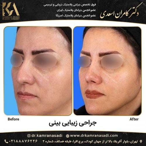 جراحی-بینی-دکتر-اسعدی-5-13