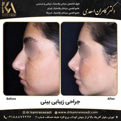 جراحی-بینی-دکتر-اسعدی-5-14