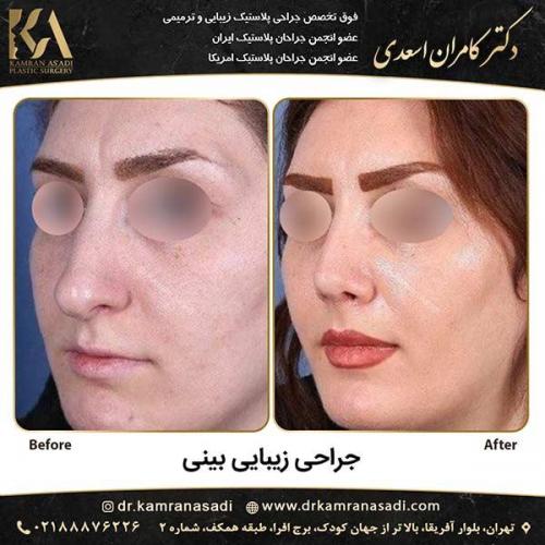 جراحی-بینی-دکتر-اسعدی-5-15