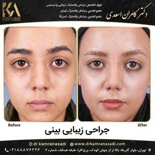 جراحی-بینی-دکتر-اسعدی-5-16
