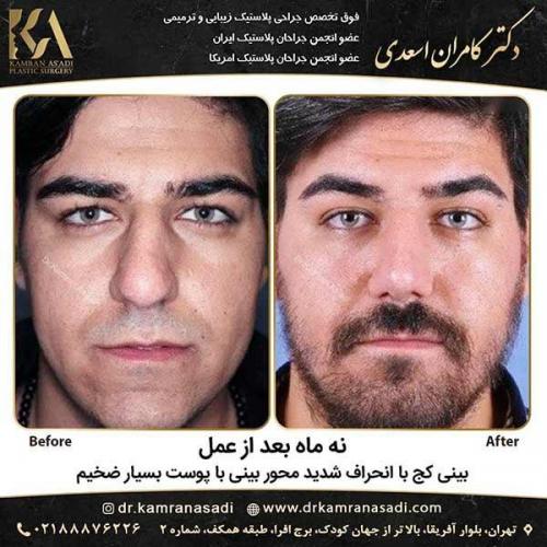 جراحی-بینی-دکتر-اسعدی-5-17