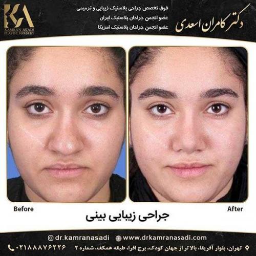 جراحی-بینی-دکتر-اسعدی-5-19