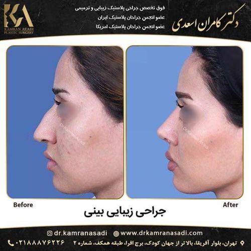 جراحی-بینی-دکتر-اسعدی-5-2