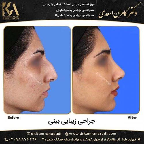 جراحی-بینی-دکتر-اسعدی-5-3