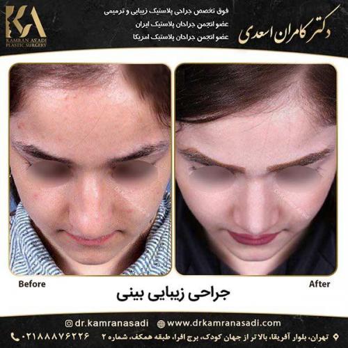 جراحی-بینی-دکتر-اسعدی-5-4
