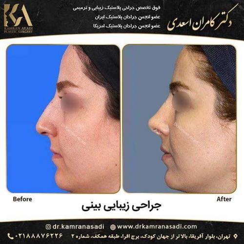 جراحی-بینی-دکتر-اسعدی-5-5