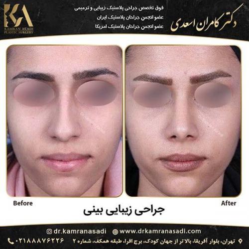 جراحی-بینی-دکتر-اسعدی-5-9